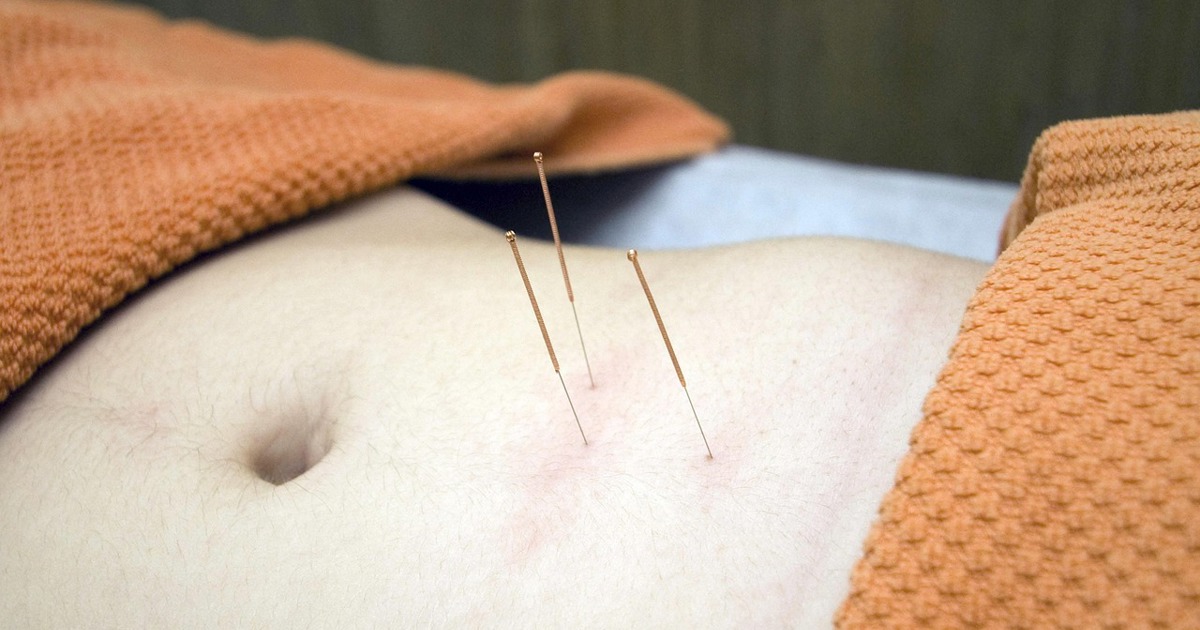 Is acupuncture worth it for back pain? New study has answers