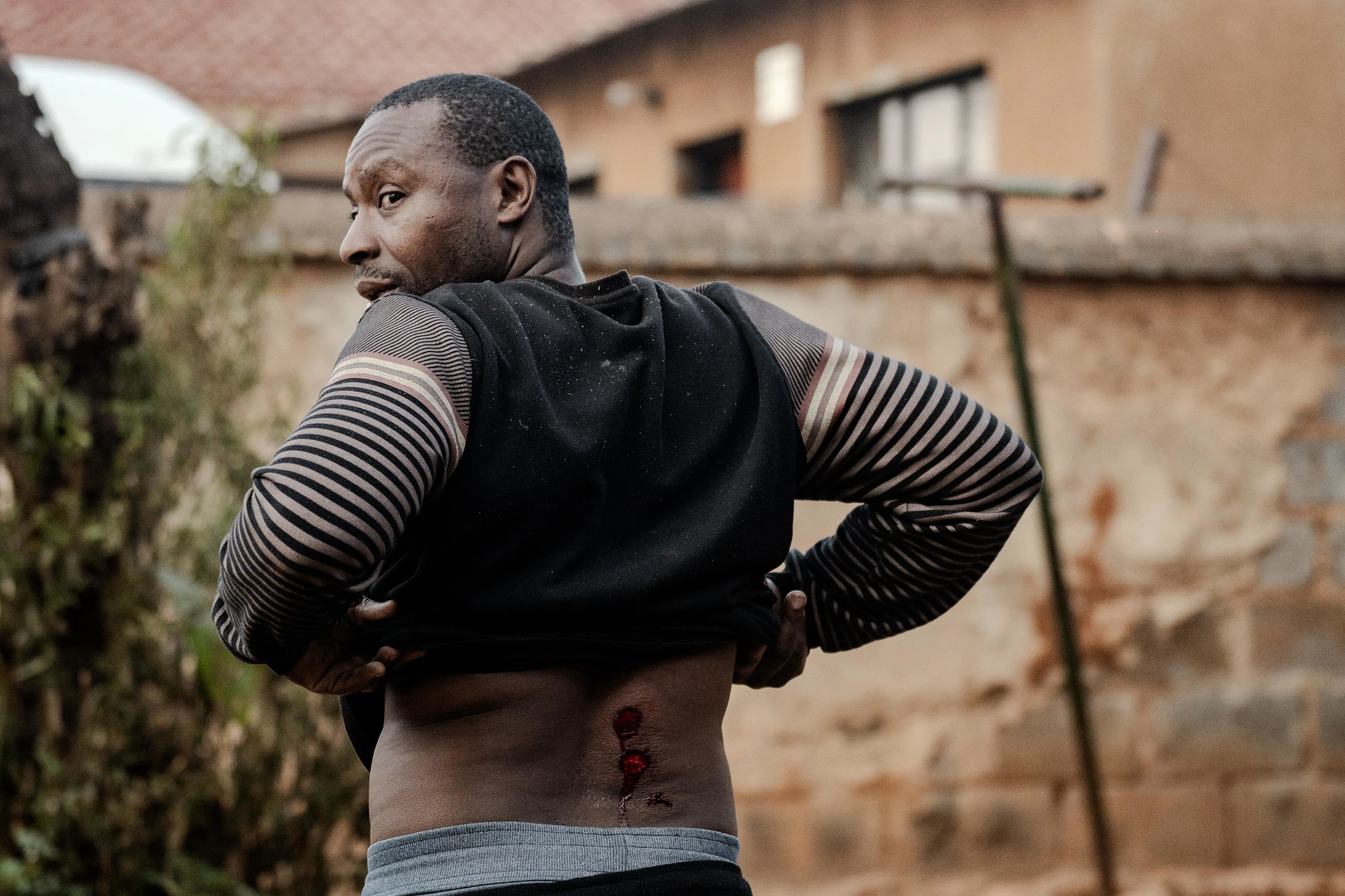 A Tembisa residents shows his wounds after being shot with rubber bullets during a protest on 21 July 2025. Picture: Sphamandla Dlamini/EWN A Tembisa residents shows his wounds after being shot with rubber bullets during a protest on 21 July 2025. Picture: Sphamandla Dlamini/EWN