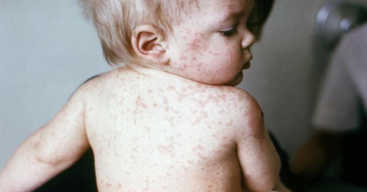 Medical expert calls for increase in measles vaccinations in Gauteng