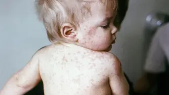 Gauteng Health Dept urges parents to protect children against measles outbreak Gauteng Health Dept urges parents to protect children against measles outbreak