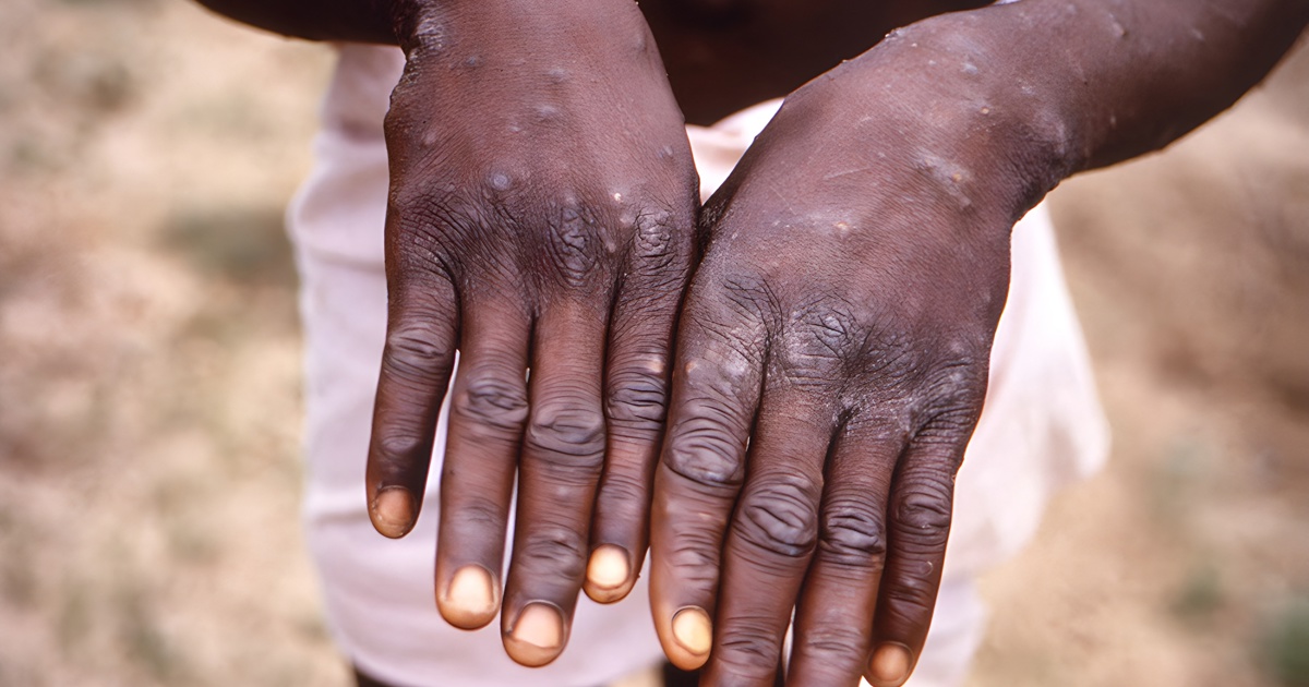 Mpox Vaccination Blitz: SA Health Department Steps Up Efforts Amid Rising Cases