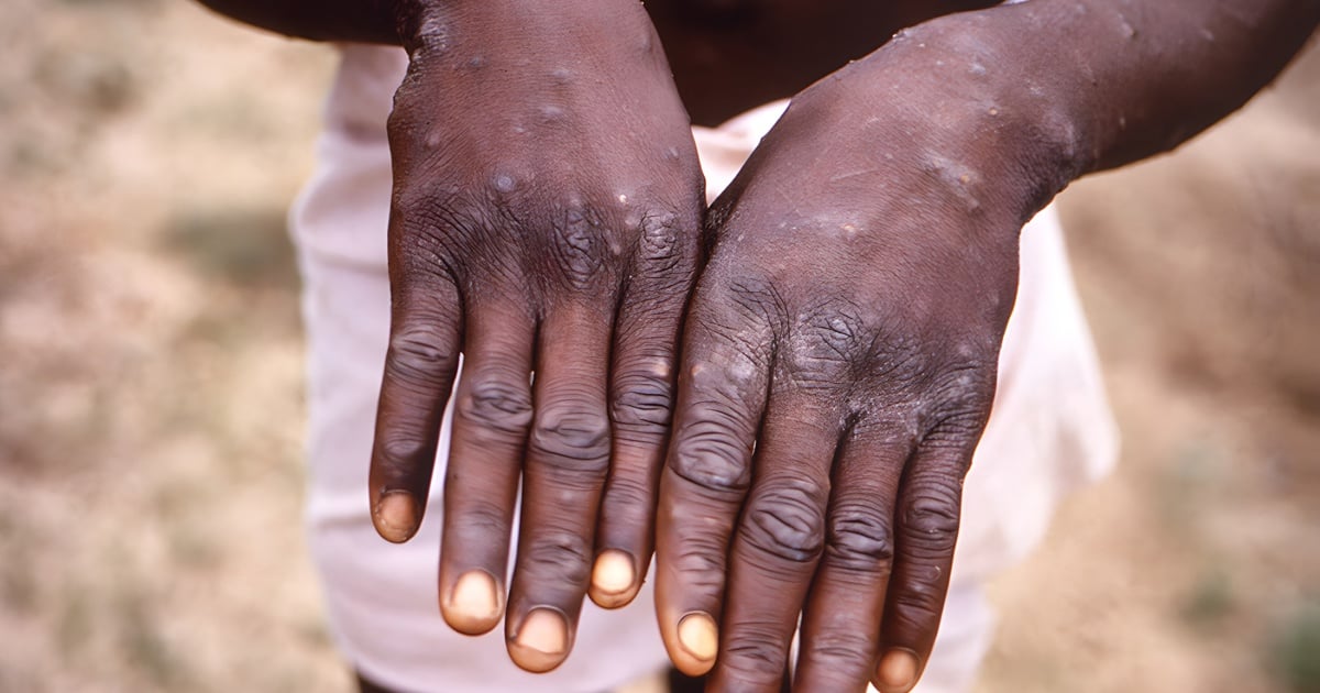 Mpox Vaccination Blitz: SA Health Department Steps Up Efforts Amid Rising Cases